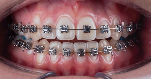 Aparelho Autoligado - Ortodontia Moderna