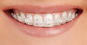 Ortodontia: Conheça os benefícios e tratamentos disponíveis